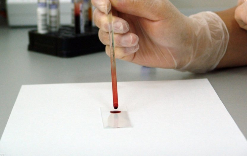 Низкий холестерин снижал риск деменции в пожилом возрасте